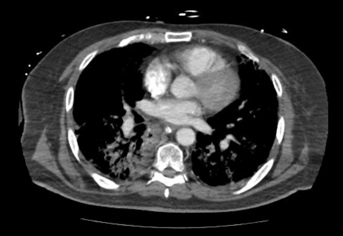 File:Acute cor pulmonale (ultrasound) (Radiopaedia 83508-98818 Axial C+ CTPA 43).jpg