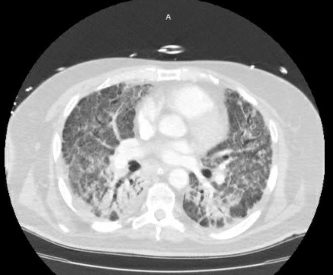 File:Acute cor pulmonale (ultrasound) (Radiopaedia 83508-98818 Axial lung window 48).jpg