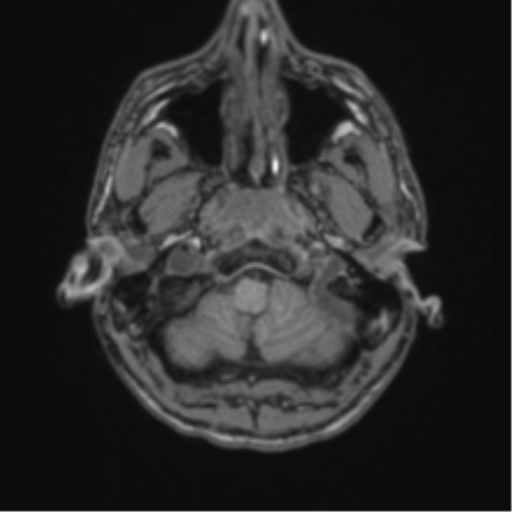 Acute disseminated encephalomyelitis (ADEM) (Radiopaedia 65319-74349 Axial T1 3).png