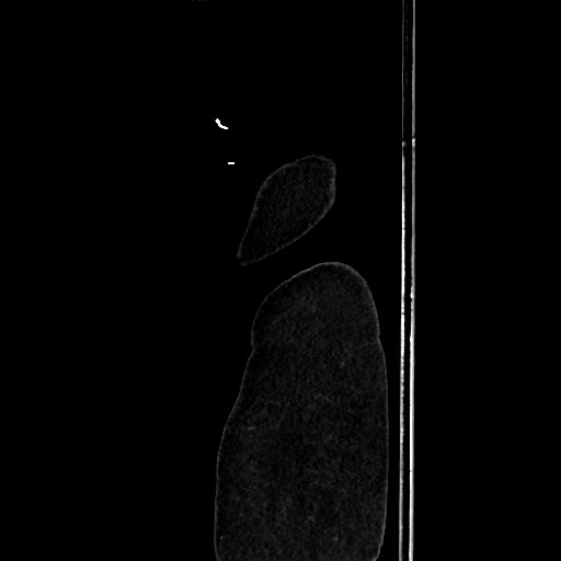 Acute diverticulitis - transverse colon (Radiopaedia 87063-103327 Sagittal C+ portal venous phase 229).jpg
