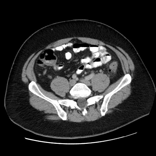 File:Acute diverticulitis with localized perforation (Radiopaedia 41296-44113 Axial C+ portal venous phase 63).jpg