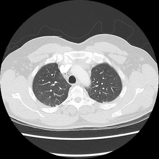 Acute epicardial fat necrosis (Radiopaedia 42327-45440 Axial lung window 18).jpg