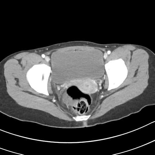 Acute gangrenous appendicitis with perforation (Radiopaedia 40152-42662 Axial C+ portal venous phase 69).png