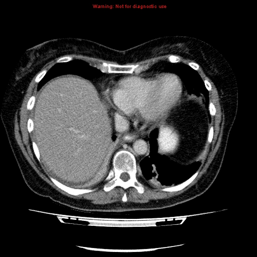 Acute gangrenous cholecystitis (Radiopaedia 10123-10661 Axial C+ portal venous phase 10).jpg