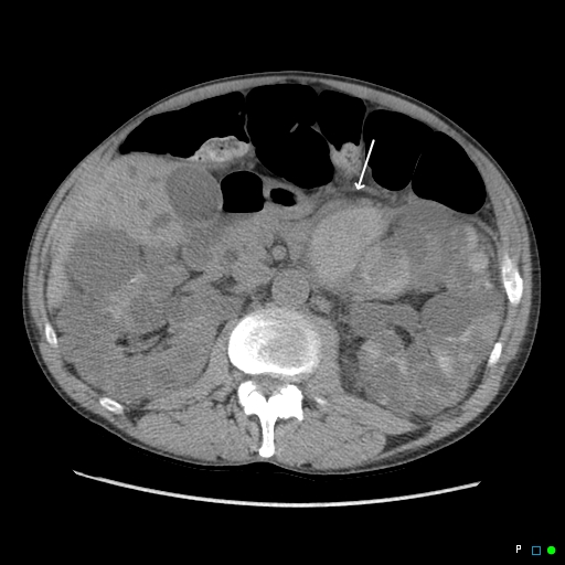 File:Acute hemorrhage in a renal cyst in polycystic disease (MRI) (Radiopaedia 41702-44641 Axial non-contrast 1).jpg