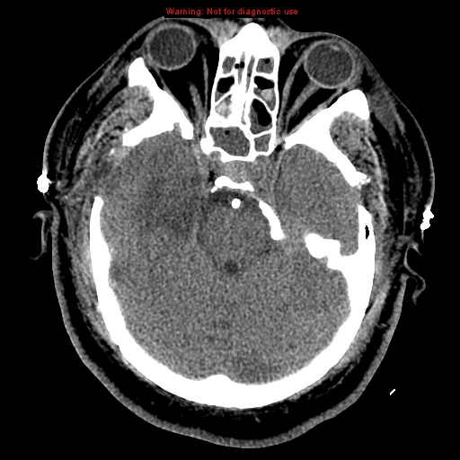 Acute hemorrhagic leukoencephalitis (Radiopaedia 14076-43697 Axial non-contrast 15).jpg