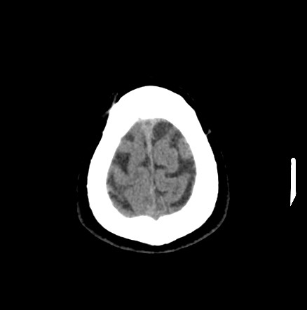 Acute internal carotid artery dissection (Radiopaedia 53541-59558 Axial non-contrast 57).jpg