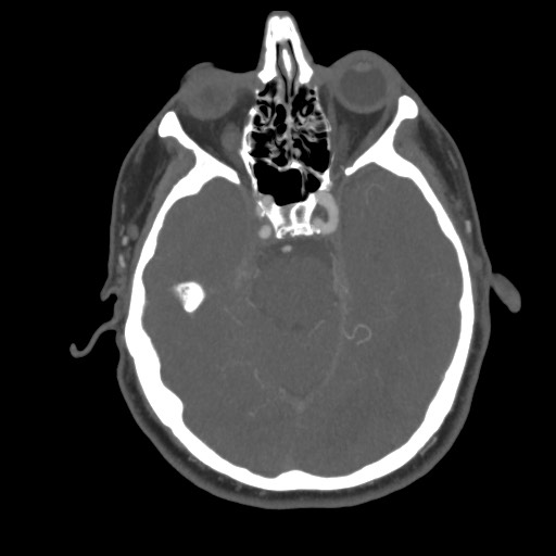 File:Acute internal carotid artery dissection (Radiopaedia 53541-59630 D 28).jpg