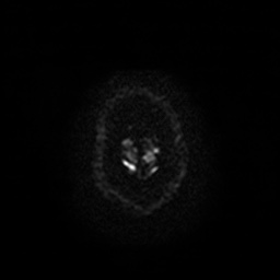 Acute internal carotid artery dissection (Radiopaedia 53541-59632 Axial DWI 30).jpg