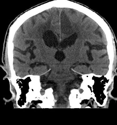 File:Acute left anterior cerebral artery territory infarction (Radiopaedia 51785-57578 Coronal non-contrast 34).jpg
