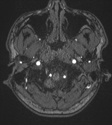 Acute left middle cerebral artery territory infarct with clot retrieval (Radiopaedia 47732-52433 Axial MRA 2).png