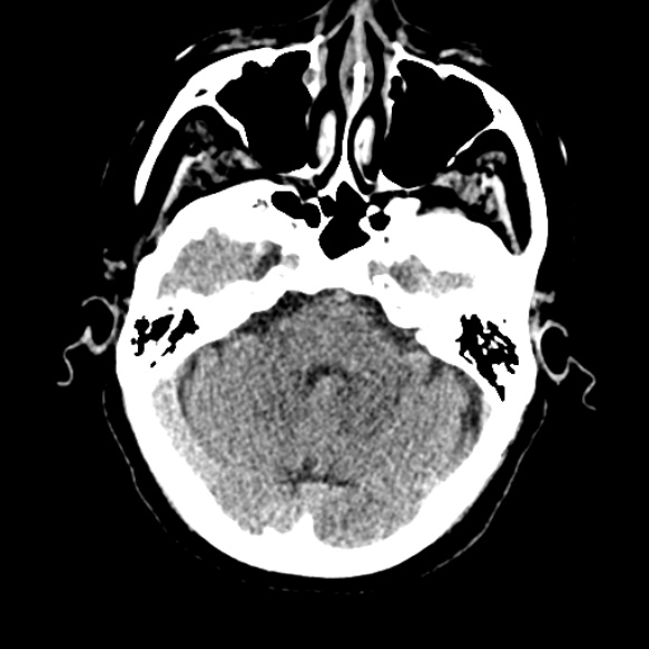 Acute middle cerebral artery territory infarct (Radiopaedia 52380-58283 Axial non-contrast 23).jpg