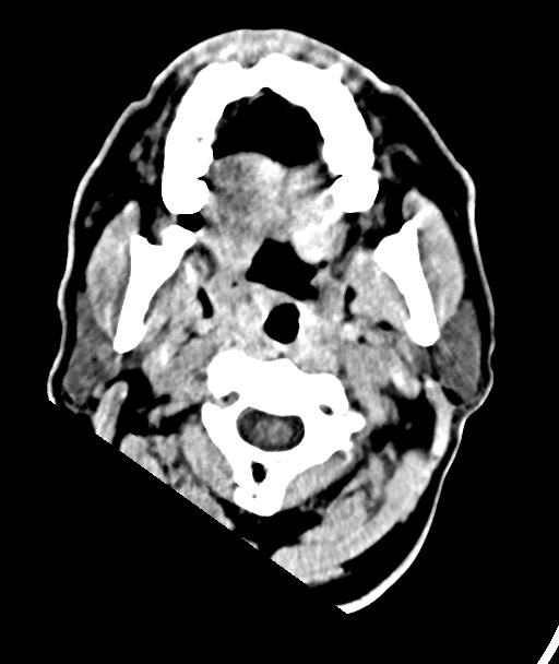 Acute on chronic subdural hematoma (Radiopaedia 78346-90966 Axial non-contrast 4).jpg