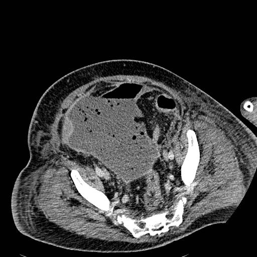 Acute pancreatic necrosis (Radiopaedia 13560-18501 Axial C+ portal venous phase 123).jpg