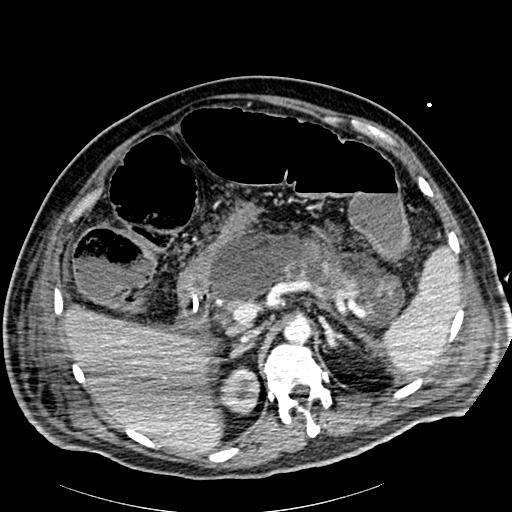 Acute pancreatic necrosis (Radiopaedia 13560-18502 Axial C+ portal venous phase 21).jpg