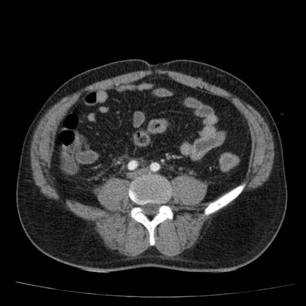 Acute pancreatitis (Radiopaedia 26663-26813 Axial C+ arterial phase 65).jpg
