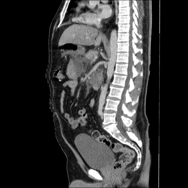 Acute pancreatitis (Radiopaedia 26663-26813 Sagittal C+ portal venous phase 39).jpg