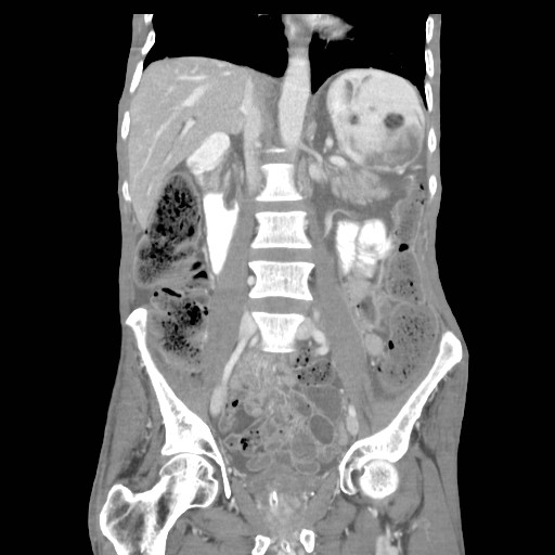 File:Acute pancreatitis (Radiopaedia 50213-55558 Coronal C+ portal venous phase 22).jpg