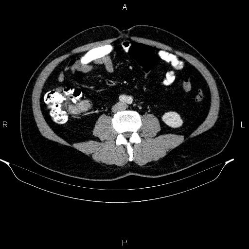 File:Acute pancreatitis (Radiopaedia 85390-101010 Axial C+ portal venous phase 63).jpg