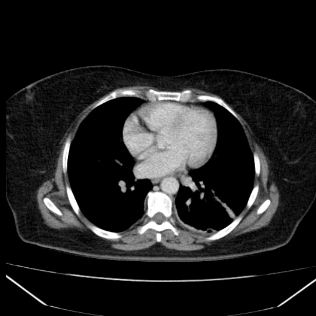 Acute pancreatitis - Balthazar C (Radiopaedia 26569-26714 Axial C+ portal venous phase 10).jpg