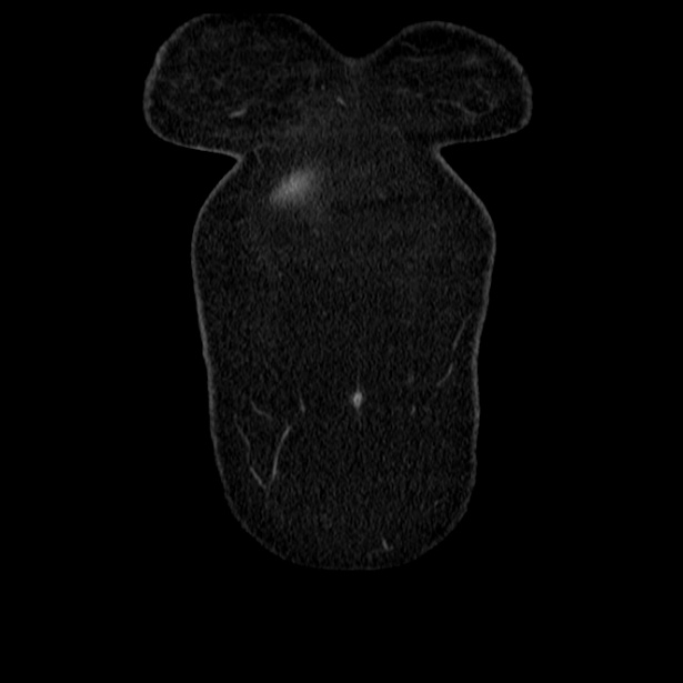 Acute pancreatitis - Balthazar C (Radiopaedia 26569-26714 Coronal C+ portal venous phase 8).jpg