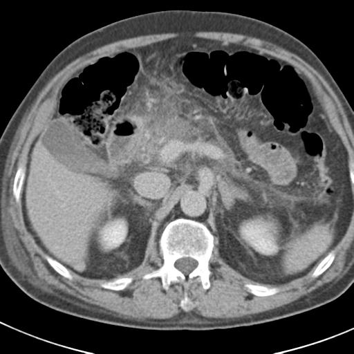 Acute pancreatitis and walled-off necrosis (Radiopaedia 29888-30403 Axial C+ delayed 29).jpg