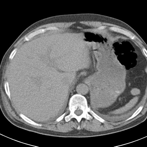 File:Acute pancreatitis and walled-off necrosis (Radiopaedia 29888-30403 Axial non-contrast 11).jpg