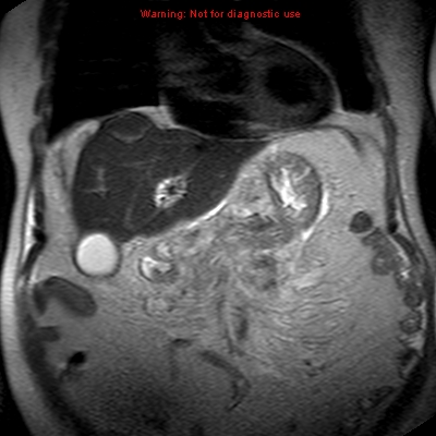 File:Acute pancreatitis with incidental pancreatic lipoma (Radiopaedia 10190-10732 Coronal T2 11).jpg