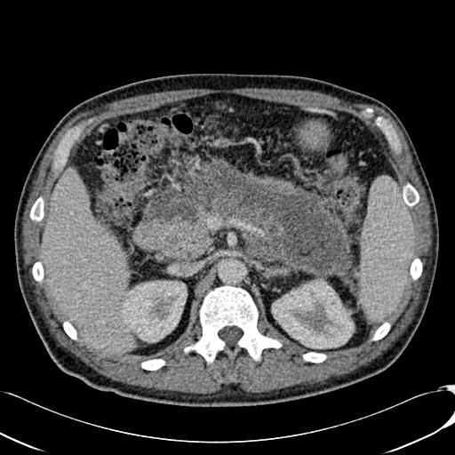 File:Acute pancreatitis with walled off pancreatic necrosis (Radiopaedia 6438-7797 Axial C+ portal venous phase 6).jpg