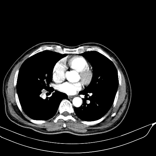 Acute pulmonary embolism (Radiopaedia 69510-79390 D 33).jpg