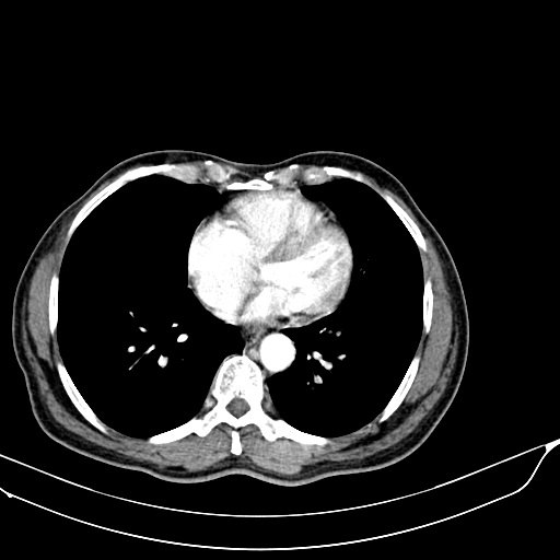 Acute pulmonary embolism (Radiopaedia 69510-79390 D 50).jpg