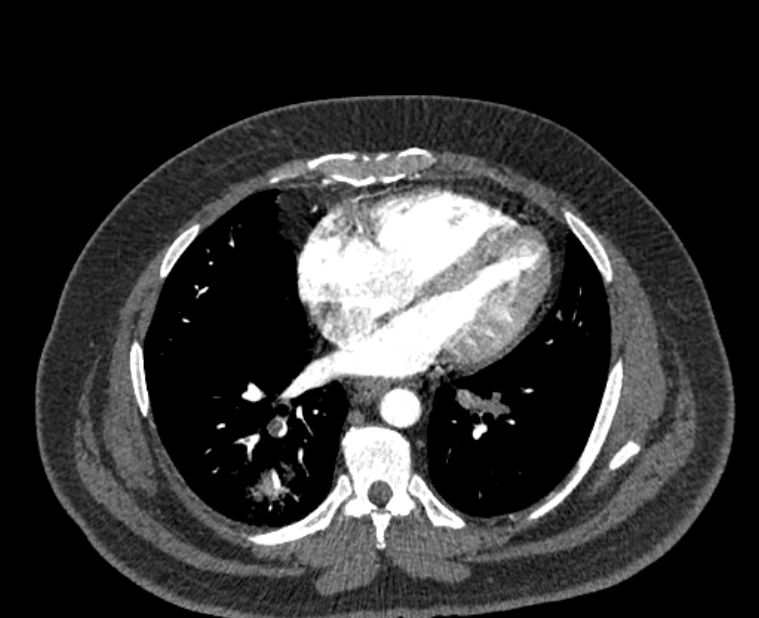 Acute pulmonary embolism with pulmonary infarcts (Radiopaedia 77688-89908 Axial C+ CTPA 42).jpg