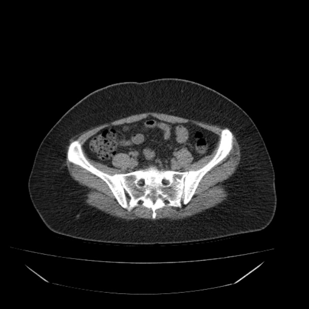 Acute pyelonephritis (Radiopaedia 33397-34434 Axial non-contrast 60).jpg