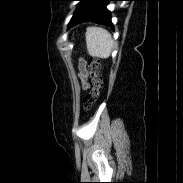 Acute pyelonephritis (Radiopaedia 33397-34434 Sagittal renal parenchymal phase 76).jpg