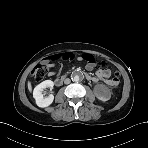 Acute renal infarction (Radiopaedia 59375-66736 Axial C+ portal venous phase 50).jpg