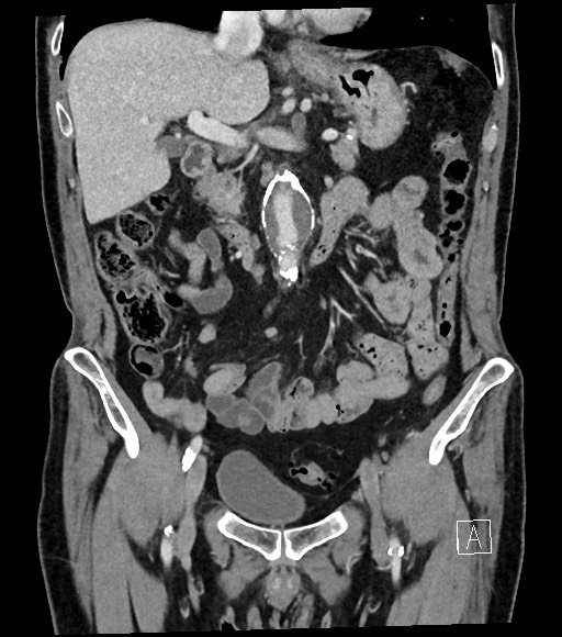 Acute renal infarction (Radiopaedia 59375-66736 Coronal C+ portal venous phase 28).jpg