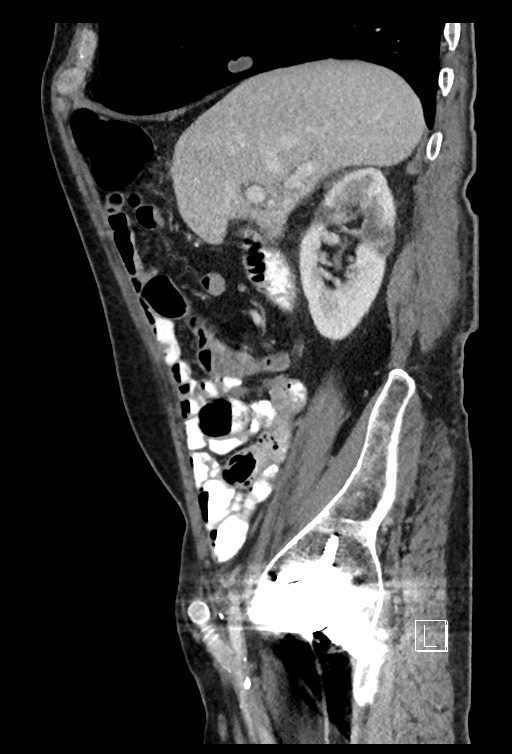 Acute renal infarction - rim capsular enhancement (Radiopaedia 59833-67270 Sagittal C+ portal venous phase 64).jpg