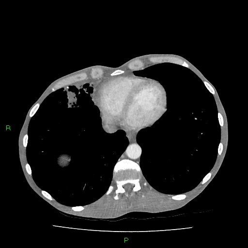 File:Acute right lung abscess (Radiopaedia 34806-36258 Axial C+ arterial phase 144).jpg