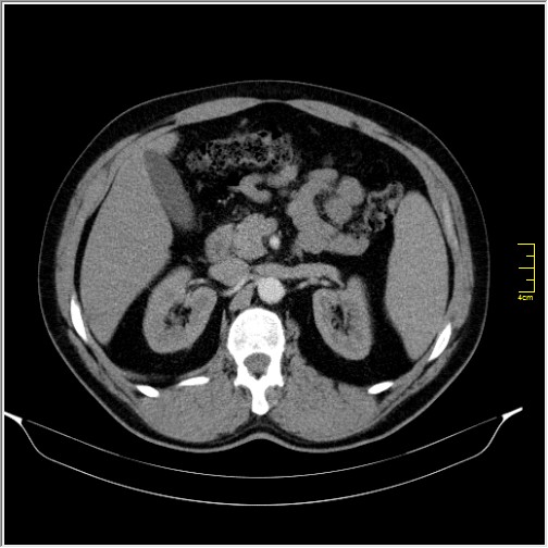 Acute right sided diverticulitis (Radiopaedia 65249-74268 Axial C+ portal venous phase 26).JPG