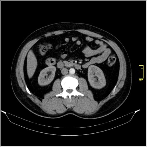 Acute right sided diverticulitis (Radiopaedia 65249-74268 Axial C+ portal venous phase 35).JPG