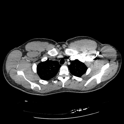 Acute segmental pulmonary emboli and pulmonary infarction (Radiopaedia 62264-70444 Axial C+ CTPA 22).jpg
