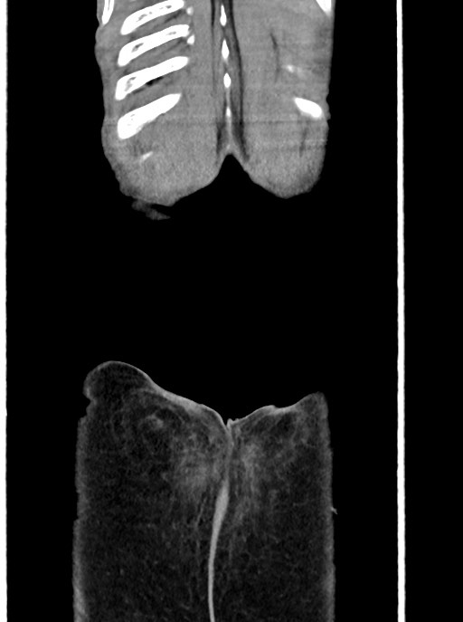 Acute small bowel (ileal) volvulus (Radiopaedia 71740-82139 Coronal C+ portal venous phase 110).jpg