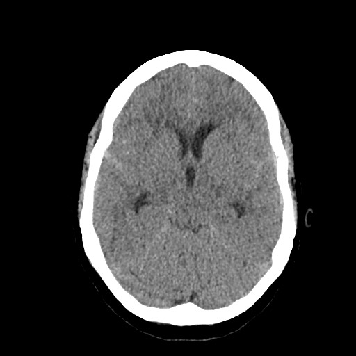 Acute subarachnoid hemorrhage and accessory anterior cerebral artery (Radiopaedia 69231-79008 Axial non-contrast 22).jpg