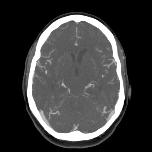 Acute subarachnoid hemorrhage and accessory anterior cerebral artery (Radiopaedia 69231-79009 D 31).jpg