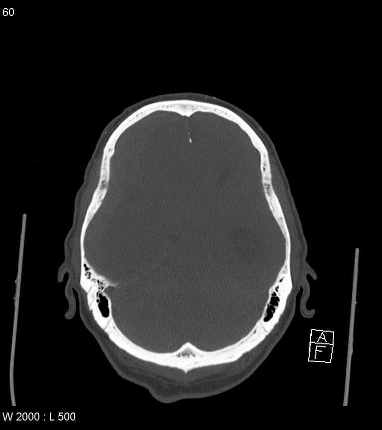Acute subdural hematoma with myelofibrosis (Radiopaedia 52582-58494 Axial bone window 30).jpg