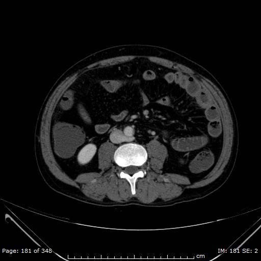 Acute superior mesenteric artery occlusion (Radiopaedia 43636-47060 Axial C+ portal venous phase 27).jpg