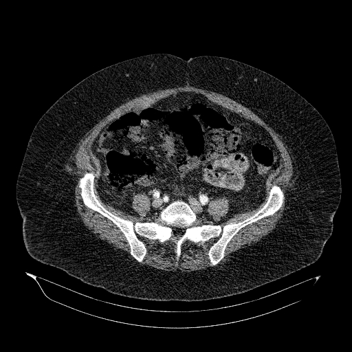 File:Acute superior mesenteric artery occlusion (Radiopaedia 51288-56960 Axial C+ arterial phase 66).jpg