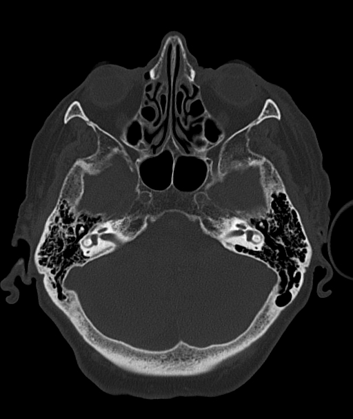 Acute traumatic subdural hematoma (Radiopaedia 82921-97257 Axial bone window 81).jpg