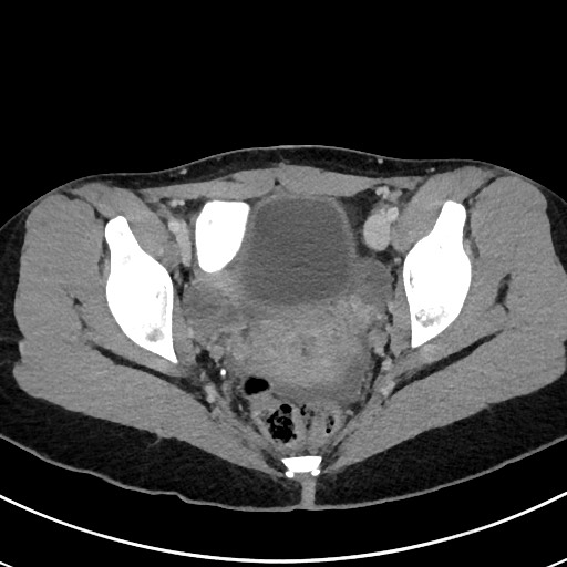 File:Acute uncomplicated appendicitis (Radiopaedia 61374-69304 Axial C+ portal venous phase 115).jpg