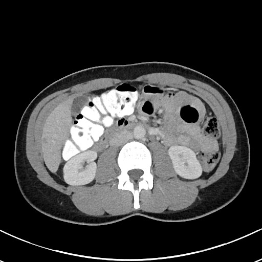 Acute uncomplicated appendicitis (Radiopaedia 61374-69304 Axial C+ portal venous phase 51).jpg